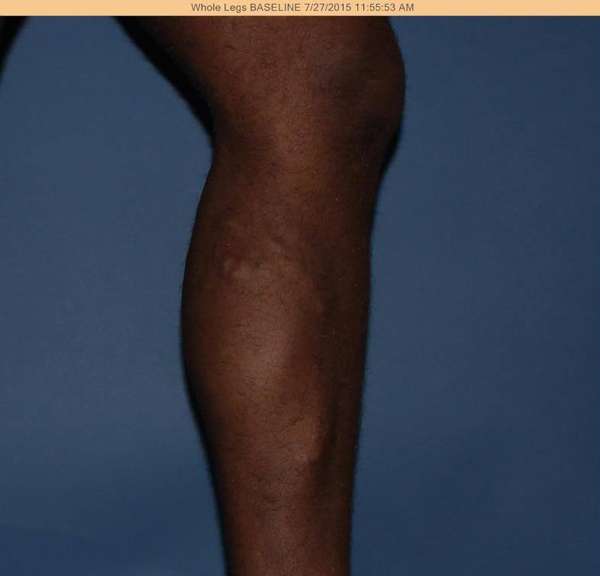 Varicose Veins