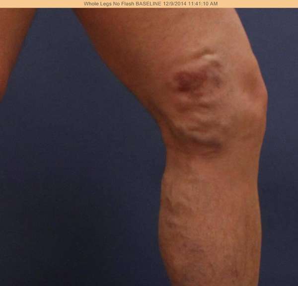 Varicose Veins