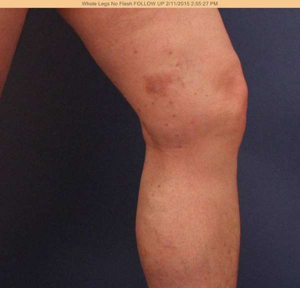 Varicose Veins