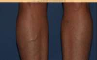Varicose Veins