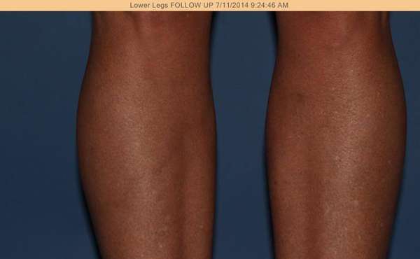 Varicose Veins