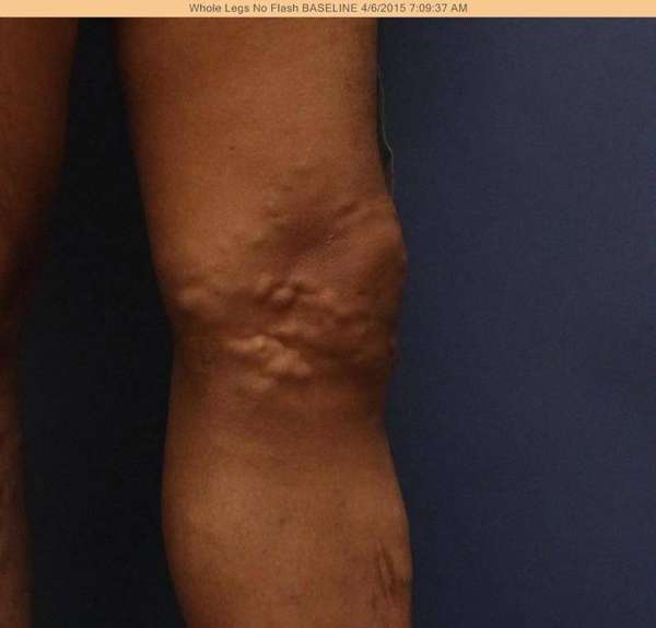Varicose Veins