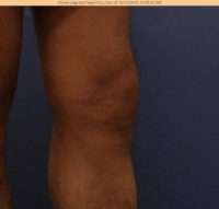 Varicose Veins