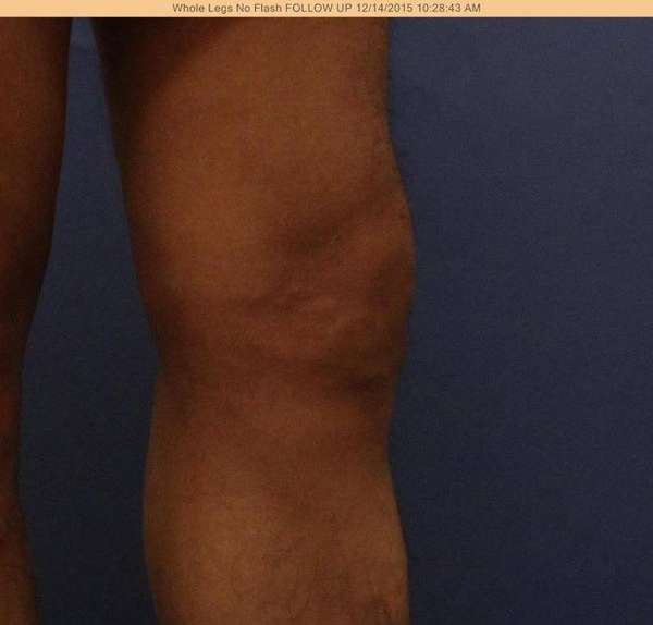 Varicose Veins