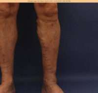 Varicose Veins