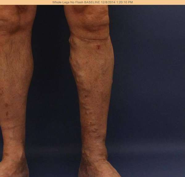 Varicose Veins