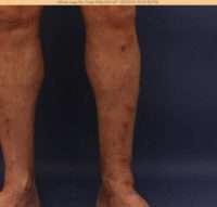 Varicose Veins