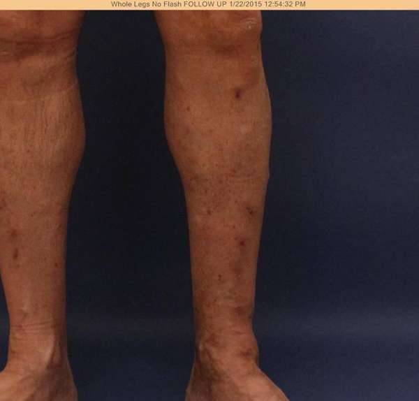 Varicose Veins