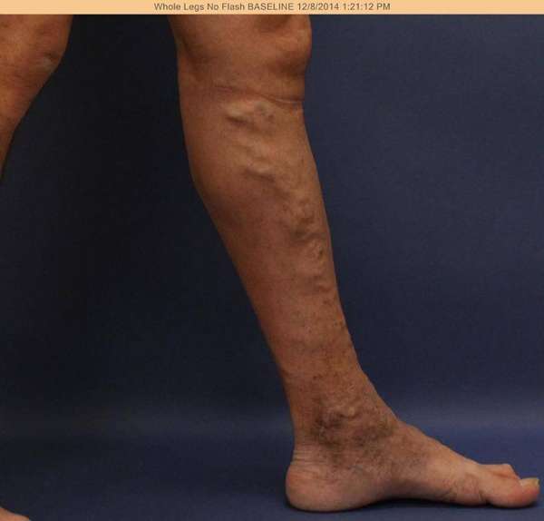Varicose Veins