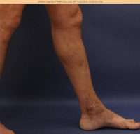 Varicose Veins