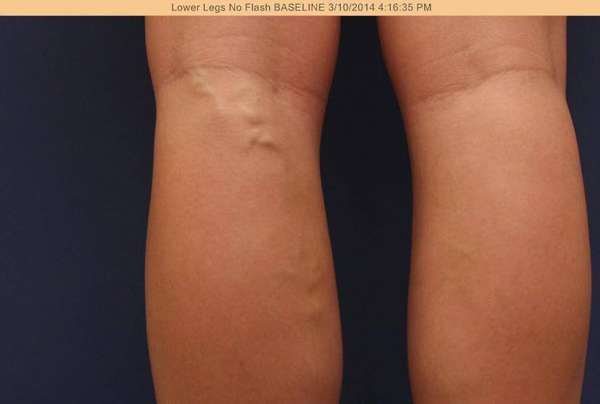 Varicose Veins