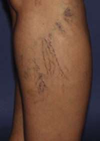 Spider Veins