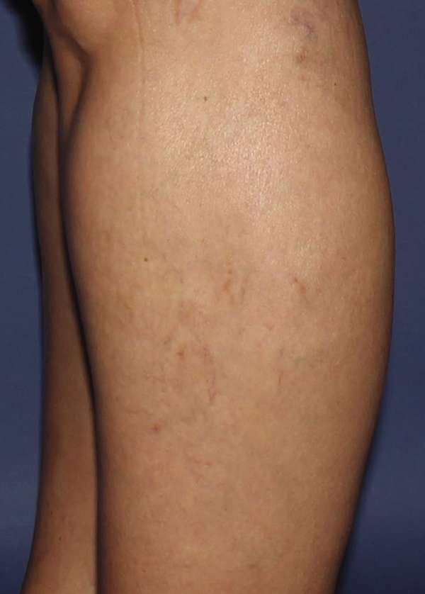 Spider Veins
