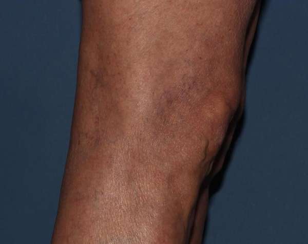 Spider Veins