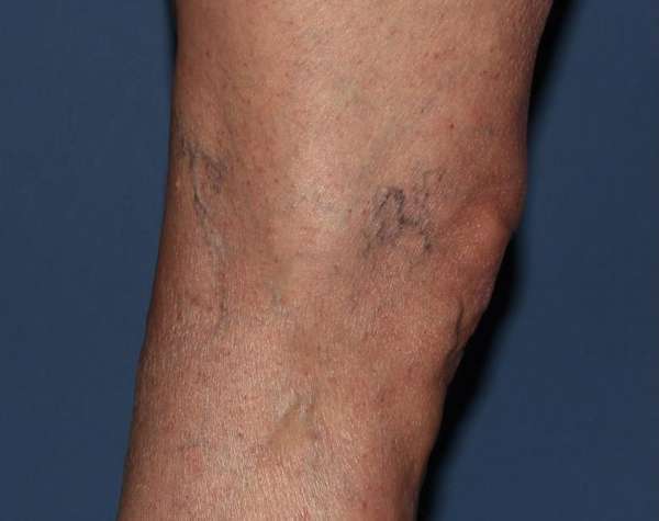 Spider Veins