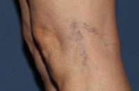 Spider Veins