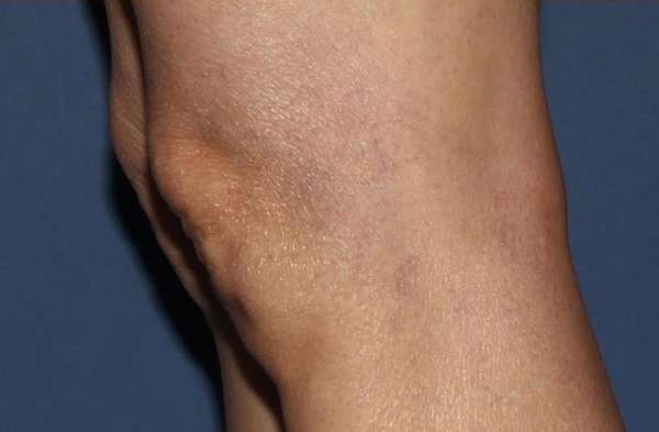 Spider Veins