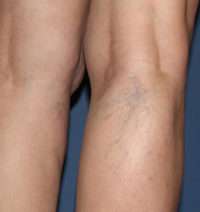 Spider Veins