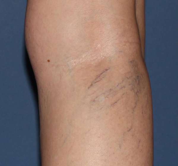 Spider Veins