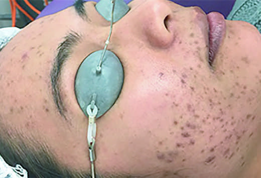Microneedling