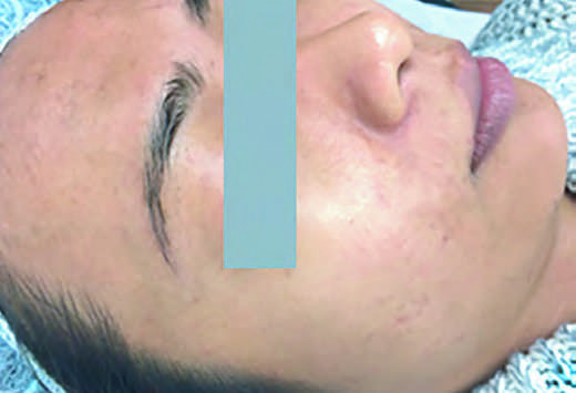Microneedling