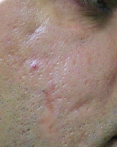 Microneedling