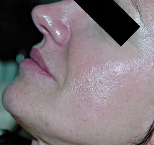 Microneedling