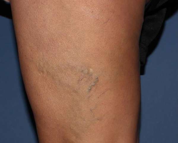 Spider Veins