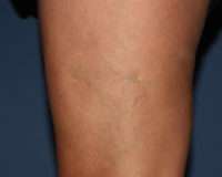 Spider Veins