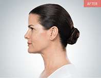 Kybella