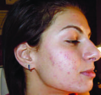 Microneedling