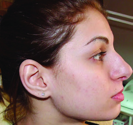 Microneedling