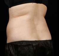 SculpSure