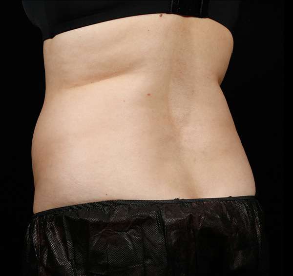 SculpSure