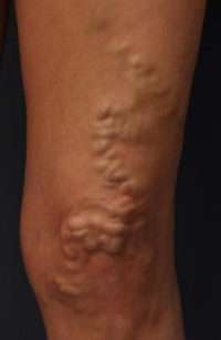 Varicose Veins