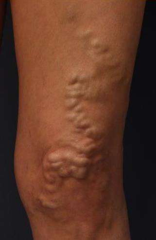 Varicose Veins