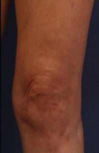 Varicose Veins