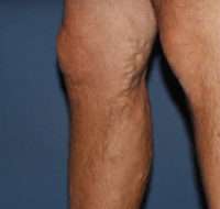 Varicose Veins