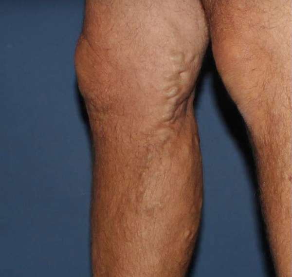 Varicose Veins