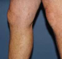 Varicose Veins