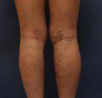 Varicose Veins
