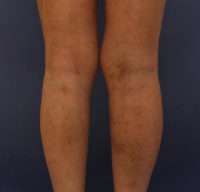 Varicose Veins