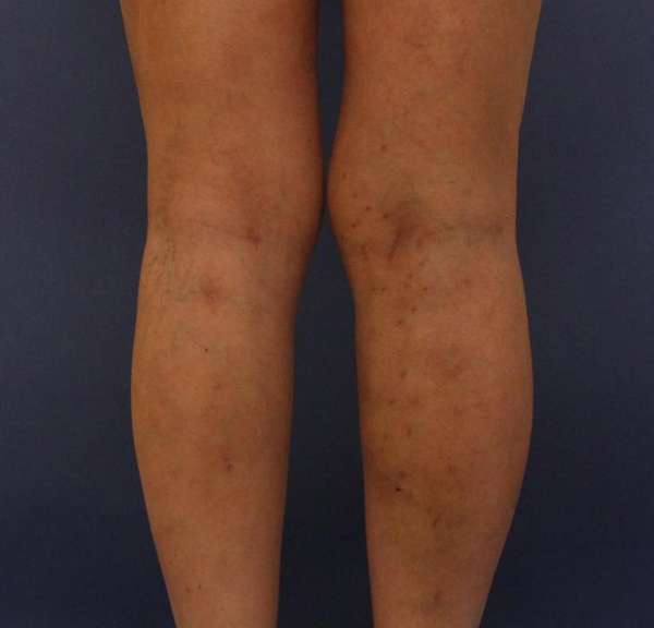 Varicose Veins