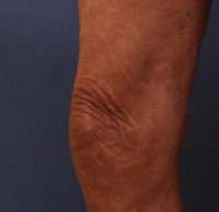 Varicose Veins