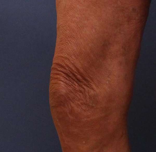 Varicose Veins