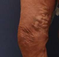 Varicose Veins