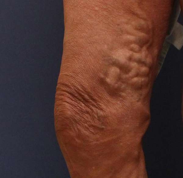 Varicose Veins
