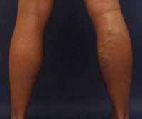 Varicose Veins