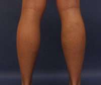 Varicose Veins