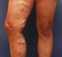 Varicose Veins